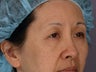 Eyelid Surgery