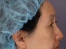 Eyelid Surgery