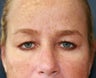 Blepharoplasty