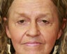 Upper Eyelid Blepharoplasty and Corner of Lip Lift