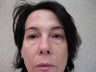 Eyelid Surgery