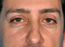 Blepharoplasty