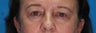 Blepharoplasty (eyelid lift)