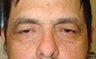 Eyelid Surgery