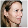Upper eyelid blepharoplasty / lower eyelid Restylane injection / endoscopic brow lift.