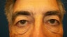 Eyelid Lift- Blepharoplasty
