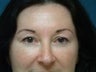 Eyelid Surgery