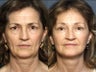 Facelift