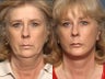 Eyelid surgery