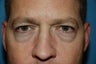 Upper and lower blepharoplasty