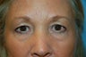 Upper and lower blepharoplasty