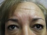 Blepharoplasty