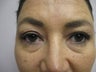 Blepharoplasty