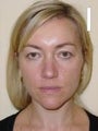 Eyelid Surgery
