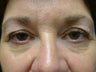 Blepharoplasty