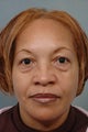 Facial Fat Transfer and Lower Blepharoplasty