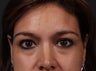 Lower eyelid and cheek rejuvenation