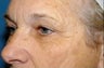 Blepharoplasty