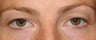 Upper Eyelid Blepharoplasty