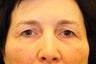 upper/lower blepharoplasty, browlift
