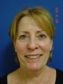 Blepharoplasty