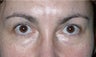 Upper and Lower Eyelid Lift 