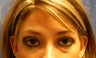 Lower Eyelid Lift