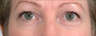 Laser Eyelid Surgery