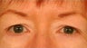 Upper Blepharoplasty (Upper Eyelids)