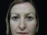 Eyelid Surgery