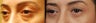 Bilateral Upper Eyelid Blepharoplasty