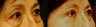 Eyelid Surgery