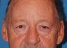 Upper and Lower Eyelid Surgery
