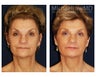Facial Rejuvenation - Eyelid Surgery