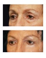 Facial Rejuvenation - Eyelid Surgery