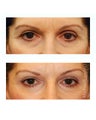Facial Rejuvenation - Eyelid Surgery
