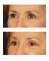 Facial Rejuvenation - Eyelid Surgery