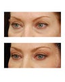 Facial Rejuvenation - Eyelid Surgery