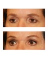 Facial Rejuvenation - Eyelid Surgery