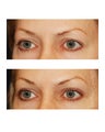 Eyelid Surgery