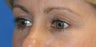 Upper Blepharoplasty and Lower Eyelid Skin Pinch
