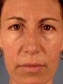 Eyelid Surgery