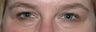 Eyelid Surgery