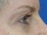 Eyelid Surgery