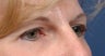 Endoscopic Browlift and Upper lid Blepharoplasty 