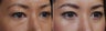 Before-After lower eyelid blepharoplasty