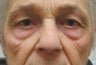 Upper  and Lower Blepharoplasty and Cheek Lift 