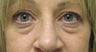 Upper  and Lower Blepharoplasty and Cheek Lift 