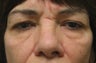 Browlift, upper and lower blepharoplasty, cheek lift 