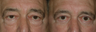 Eyelid Surgery